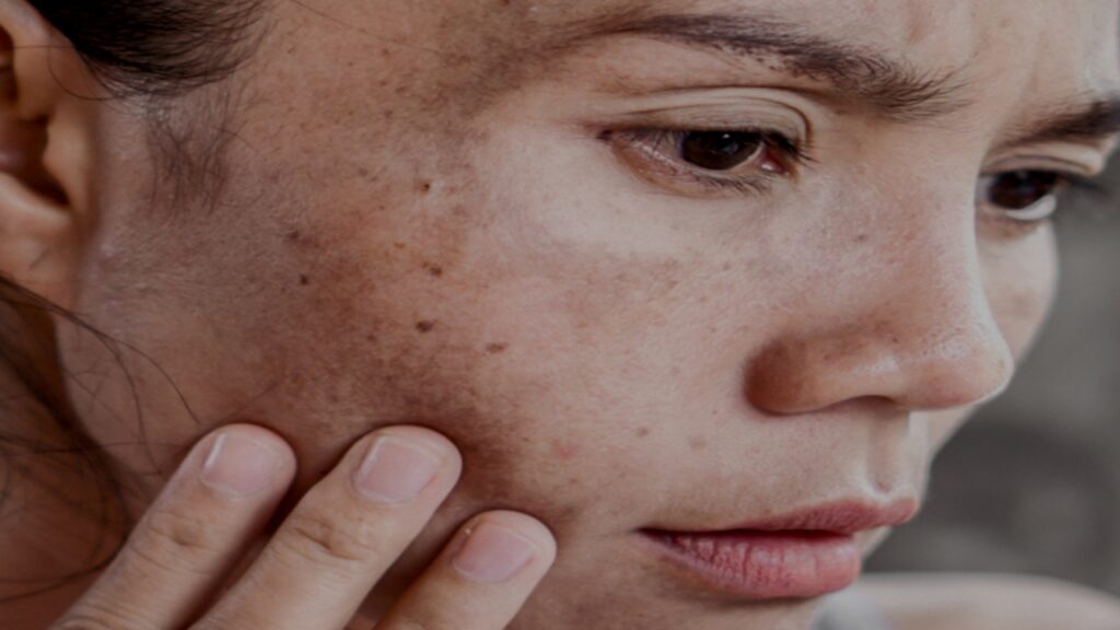 Pigmentation Problem